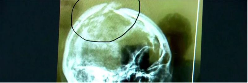 Imagem do crânio da assistente social Márcia Miranda mostra que ela levou pancada na cabeça 